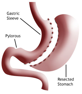 Gastric sleeve; to virkningsmekanismer 1.