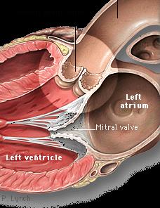 complications during surgery. Mortality for untreated Symptomatic Severe Aortic Stenosis is around 50% at 2 years.