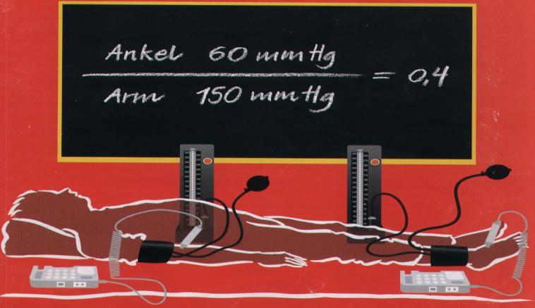 eller ikke Ankel / arm indeks Normalt: > 0,9 Full kompresjon hvis: > 0,8 Claudicatio intermittens: 0,6 Hvilesmerter: 0,3 Gangren og sår: < 0,3 Henvisninger Tidligere sykdommer og medisiner Hvordan er