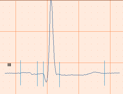 4.12 Bruke støyfilter EKG-kurvene kan inneholde støy forårsaket av forstyrrelser fra strømnettet. Dette gjør kurvene vanskeligere å tyde. Du kan filtrere bort støy ved å bruke nettstrømfilter.