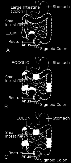 Lokalisering av Crohn s sykdom Klassifikasjon av CD ved inklusjon i IBSEN studien (1990
