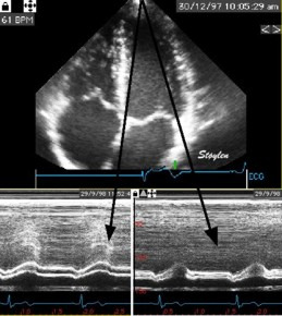 Apikal M-mode M annulusforkortning Mitral annular excursion (MAE/ MAPSE);