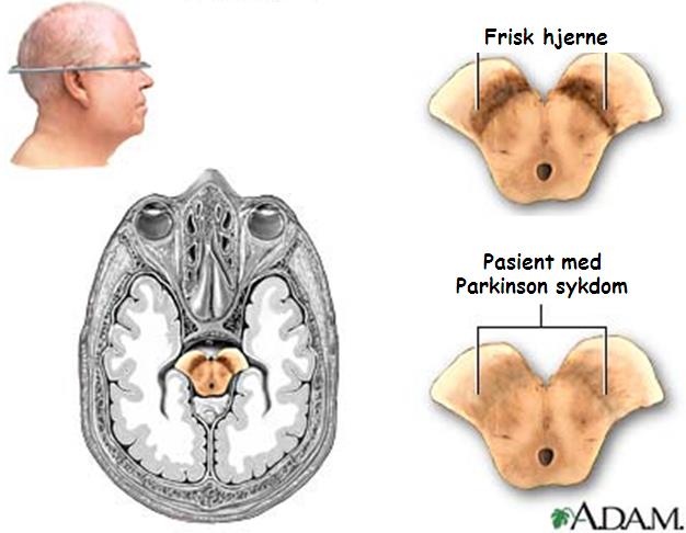 Parkinsons sykdom - utvikling Ikke-motoriske symptomer Søvnrelaterte forstyrrelser Insomni