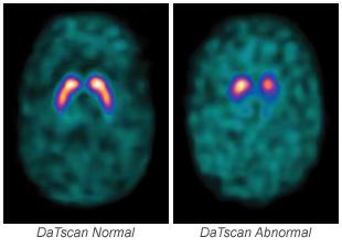 ROMOPPFYLLENDE PROSESSER Subdural blødning MRI CT Frontal brain tumor,mri CT av pasient med Alzheimer sykdom Forstørrede ventrikler og den høyre Sylvian fissure MR bilde: -
