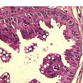 Det sees varierende grad av intraduktal epitelproliferasjon. 5. Radiært arr Kjertlene ligger i et fibroelastotisk vev. Det er ingen desmoplastisk stromareaksjon.