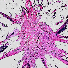 Intraduktale epitelproliferasjoner s. 10 4.