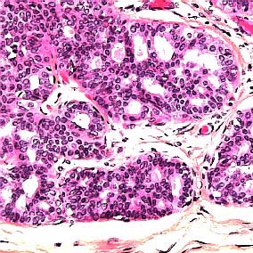 Intraduktale epitelproliferasjoner s. 12 10. IDH Det sees uttalt intraduktal epitelproliferasjon med hulrom både perifert og sentralt. Cellebildet er uryddig og uten cellulær atypi.