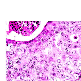 DCIS, grad II Bildet viser atypiske celler med solid vekstmønster. Kjernene er i gjennomsnitt i underkant av 2 erytrocyttdiametre.