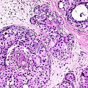 Intraduktale epitelproliferasjoner s. 21 37.