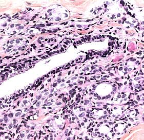 Intraduktale epitelproliferasjoner s. 22 40. DCIS, grad III med lobulær kanserisering og sklerose («pseudoinfiltrasjon») Dette må ikke forveksles med invasivt karsinom.