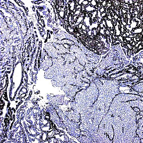 Intraduktale epitelproliferasjoner s. 24 46. Intraduktalt papillom med overgang til DCIS Perifert i lesjonen sees proliferasjon av tubuli og bindevevsstroma.