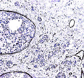 Intraduktale epitelproliferasjoner s. 25 49. DCIS, grad III, med mikroinvasjon Til venstre sees atypisk intraduktal epitelproliferasjon.