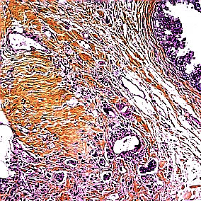 Intraduktale epitelproliferasjoner s. 26 52. DCIS med kontaminasjon av stikkanalen etter nålebiopsi Øverst til høyre sees del av DCIS. Det er tidligere gjort en grovnålspunksjon.