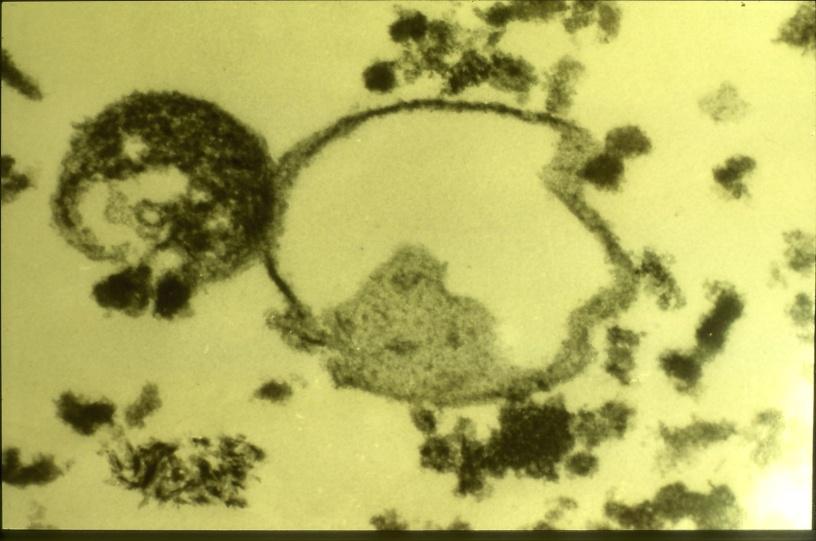 Borrelia burgdorferi cyster in vivo. Spv Cyster fra en MS (NB) pasient observert i elektron mikroskop. Pasienten hadde vært behandlet iv med ceftriaxone i 4 mnd.