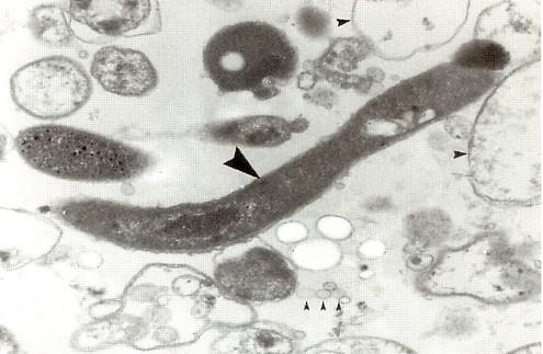 Borrelia burgdorferi cyster in vivo Cyster i spv of MS pasienter.