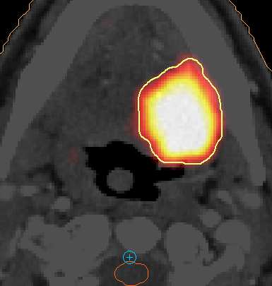 Problemet: Positron emission tomography (PET) Hvordan bestemmer