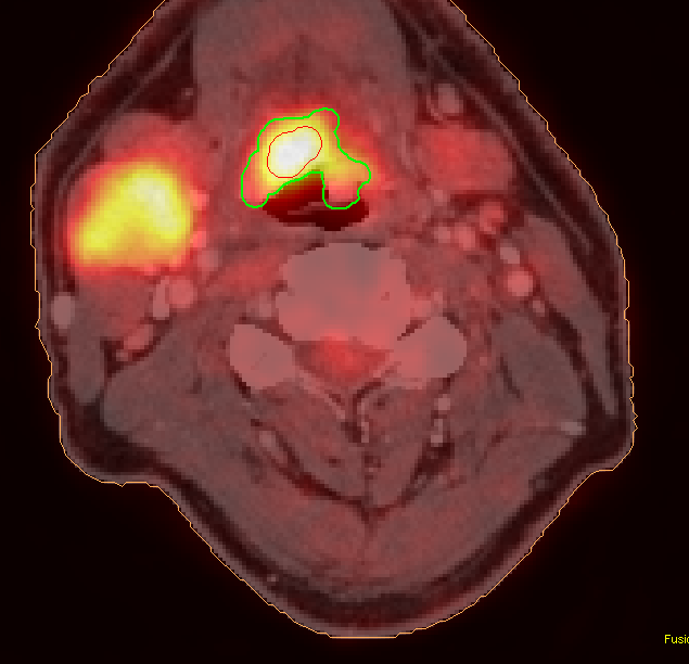 FDG PET/CT SCC, Tungeroten (T2N2cM0) a) Skalér til sann størrelse og tegn tumor-omriss i en rekke påfølgende 2