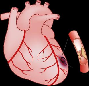 Rytmeforstyrrelse Hypotermi 30 % Resp.