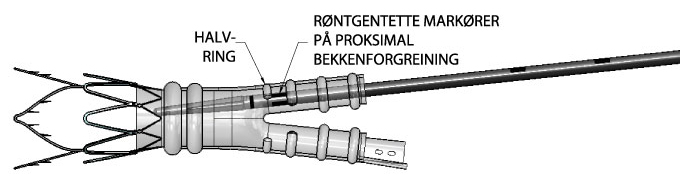 4 Bruk fluoroskopi og følg jevnlig med at graftet fylles med den røntgentette fyllpolymeren.