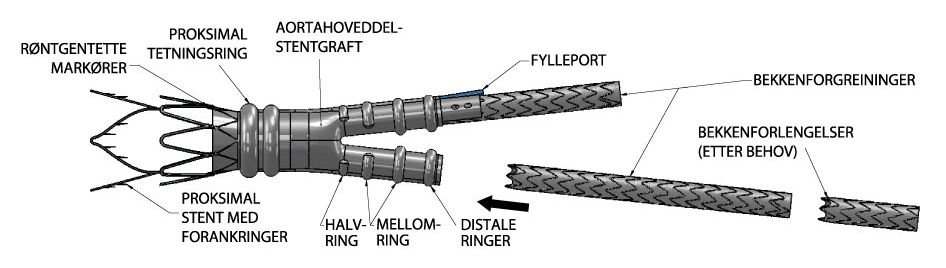 1. Beskrivelse av enheten TriVascular Ovation Prime abdominal stentgraft-system er en endovaskulær enhet som innføres via et lavprofil-kateter for behandling av abdominale aortaaneurismer (AAA-er).