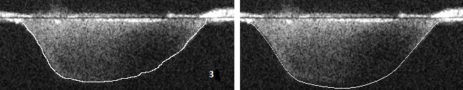 4.3. SAMMENLIGNINGER 47 Figur 4.14: maks dp/dt: 987 mmhg/s vs. 1401 mmhg/s antar at kanten ligger høyere enn hva den manuelle sporingen gjør. Figur 4.15 viser et annet bilde med en uklar kant øverst, men her er forskjellen mellom den manuelle sporingen og den automatiske mindre.