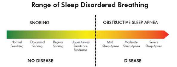 Obstruktiv søvn apne (OSA) Snorking mer enn 50% voksne
