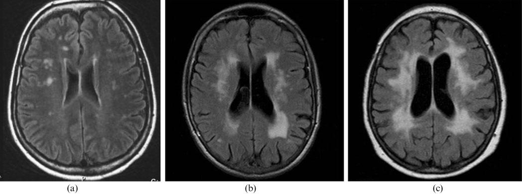 White matter changes in dementia: does radiology matter? Pictures of different grades of white matter changes on MRI. According to the Wahlund scale.