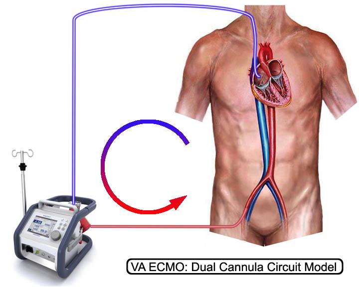 ECMO Ekstrakorporeal membranoksygenering Hva er planen?