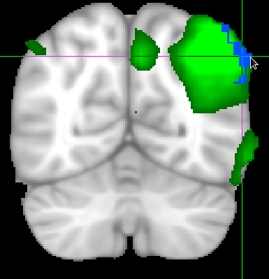 F. fmri av hjernen