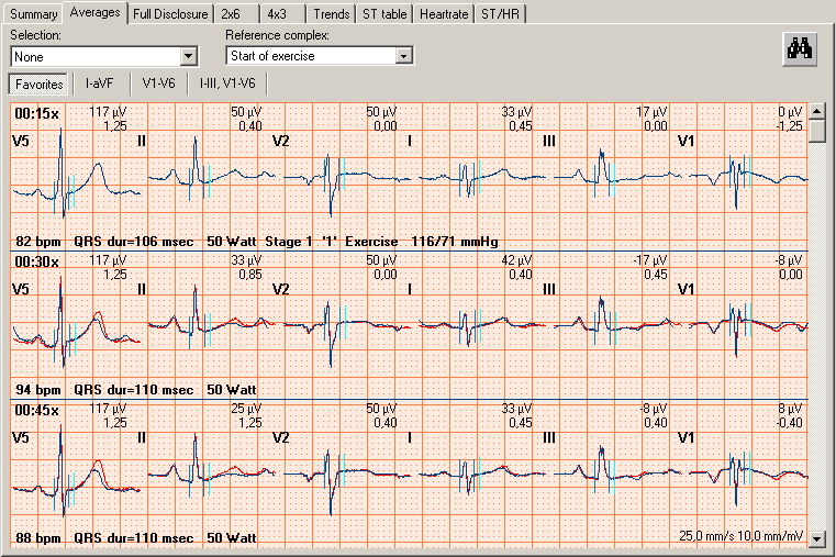 Trender og diagrammer ST-tabell Hjertefrekvenstrend ST-trend Blodtrykk En oversikt over ST-verdier, som beregnet i STtabellvisningen. Hjertefrekvenstrenden som beregnet i hjertefrekvensvisningen.