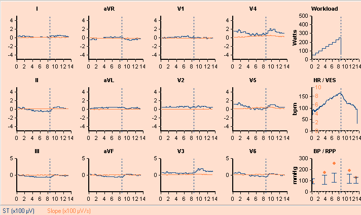 4x3-visning 4x3-visningen viser en 12-avlednings EKG-strimmel. Avledningene vises i 4x3-konfigurasjon med rytmestrimmel nederst. Visningen kan være simultan eller sekvensiell.