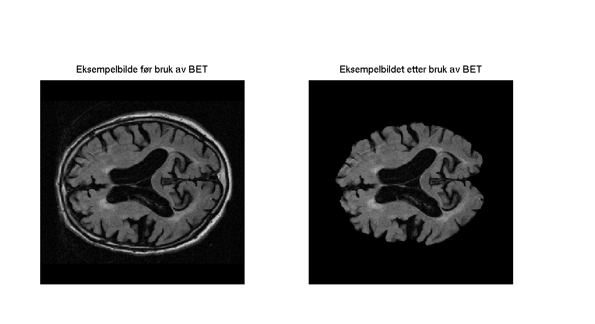 Figur 3.2. Figuren viser et eksempelbilde før og etter bruk av BET (Brain Extraction Tool). En ser at skallen og annet vev fjernes, mens hjernen segmenteres ut.