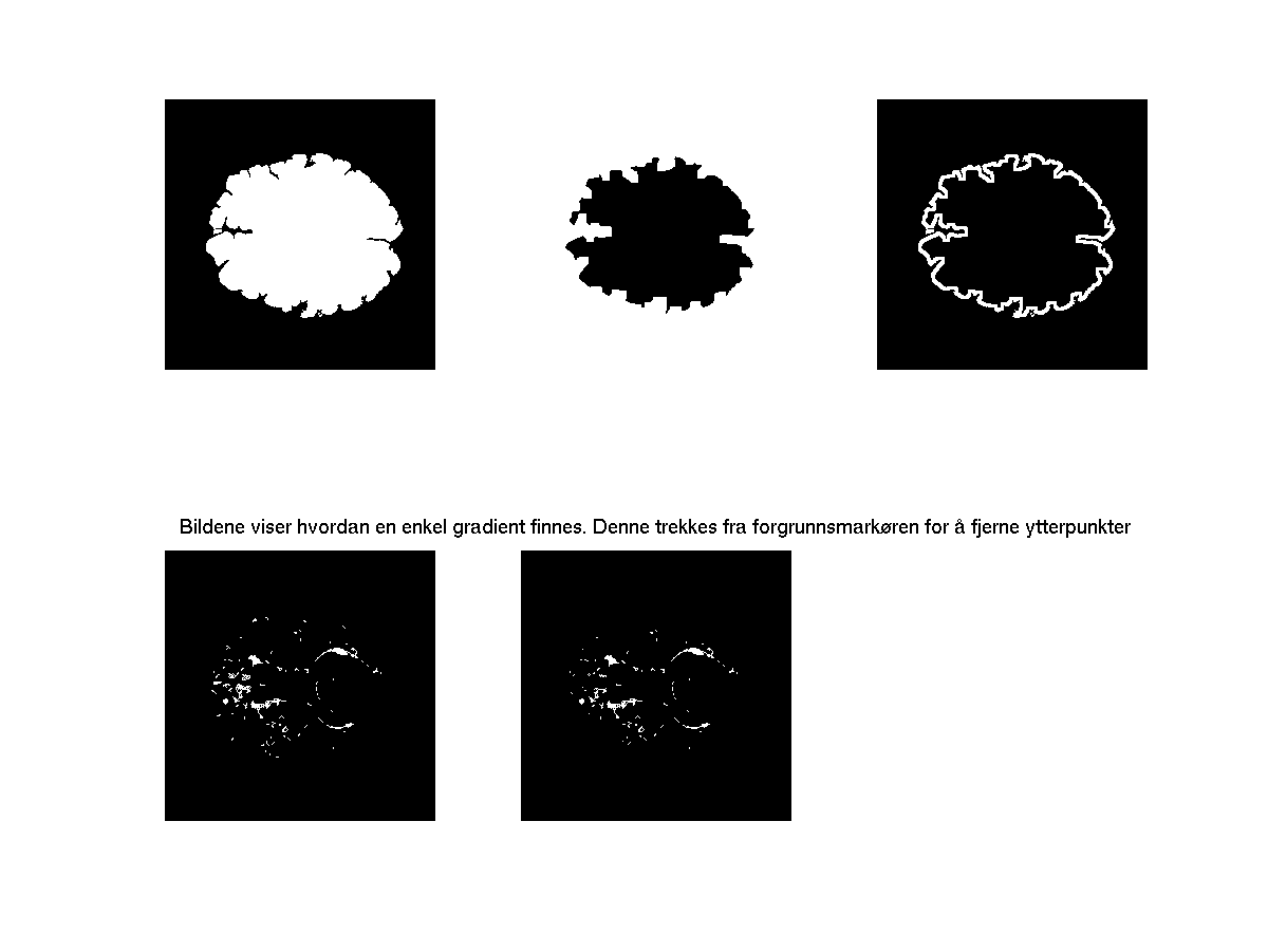 Figur 3.4. Figuren viser hvordan en enkel gradient om hjernen finnes, ved at hjernen først fylles, og en omvendt, erodert versjon av samme bilde trekkes fra.