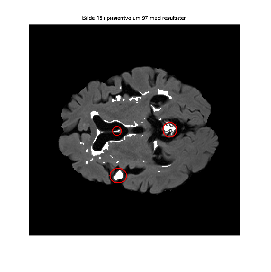 I figur 4.3 under ser en nærmere på resultatbildet for pasientvolum 97. Detekterte områder en kan se bort fra er markert med rødt.