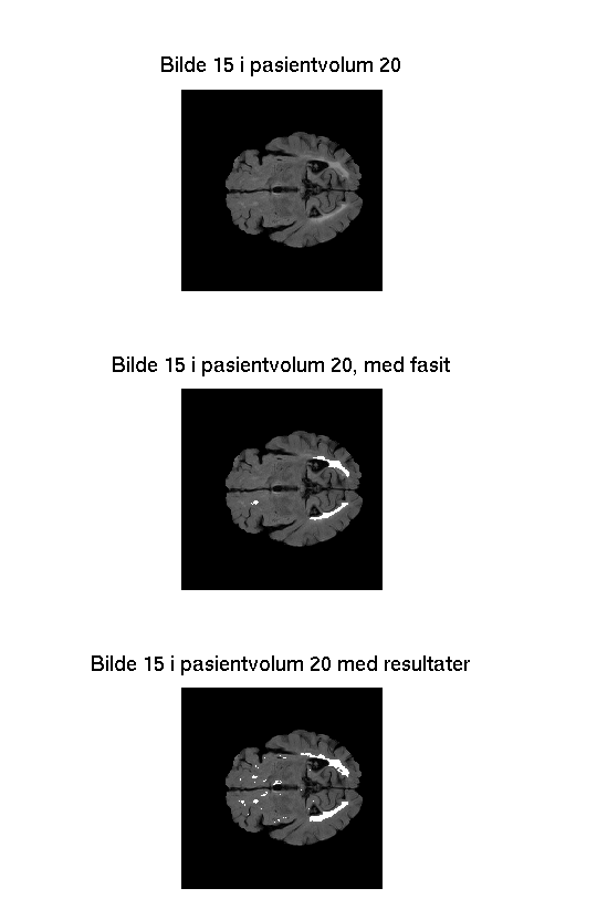 Figur 4.5. Figuren viser bilde 15 fra pasientvolum 20, tabell 6.