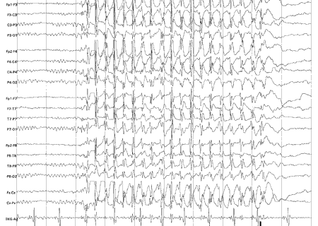 Generalisert Anfall Tonic clonic (og alle kombinasjoner) klassisk GTK Absencer Typisk(3/sekunde mønster på EEG) Atypisk (uten spesifikk mønster) Absencer med spesielle
