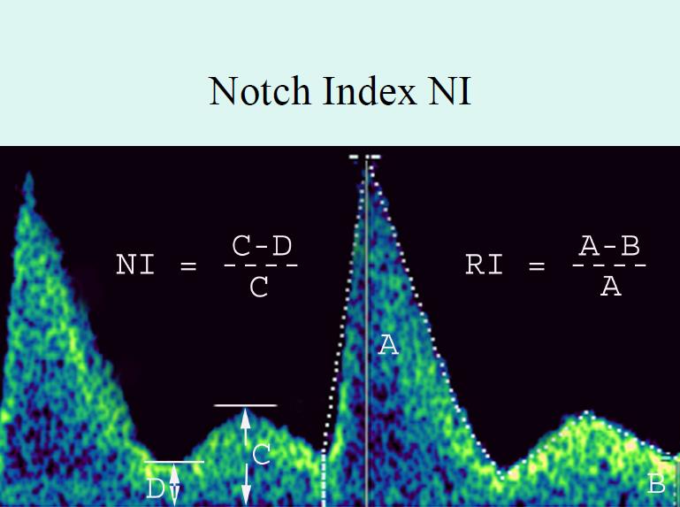 A notch is defined as a persistent decrease in blood