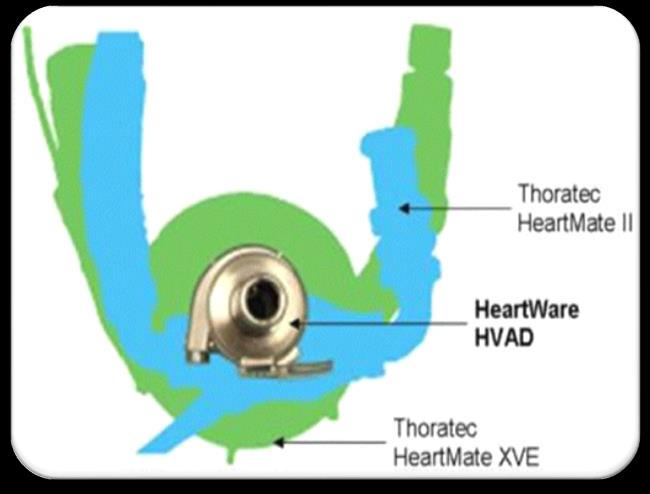 Teknisk utvikling LVAD Pulsatile LVAD Store Mye lyd Kirurgisk traume Infeksjon Fysisk