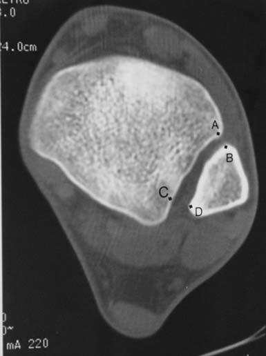 Dikos et al: J Orthop Trauma; Volume 26, 7, 2012 Gardner et al: Foot & Ankle International/Vol. 27, No.