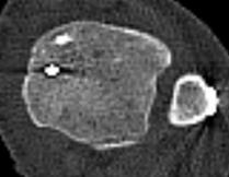 The reduction of the syndesmosis The TibioFibular distance Outcome measure TF > 1.