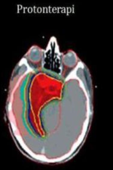 Hvorfor protonterapi?