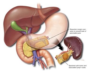 Pancreas cancer 10-20% Resektable Median overlevelse 16-24 mnd 5-års overlevelse 15% 30-40% Lokalavansert Ikke-resektable Median overlevelse 6-12 mnd 50-60% Metastatisk sykdom ved