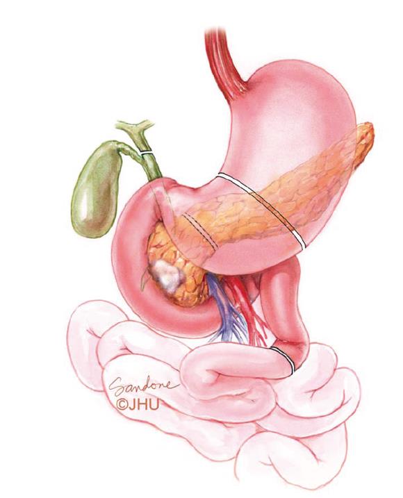 Pancreatoduodenectomi