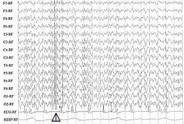 EEG (Elektroencefalografi) EEG-registrering under anfall kan bekrefte at et anfall er epileptisk. Rutinediagnostikk i humanmedisinen. Interiktalt sensitivitet og spesifisitet ikke så bra på hund.
