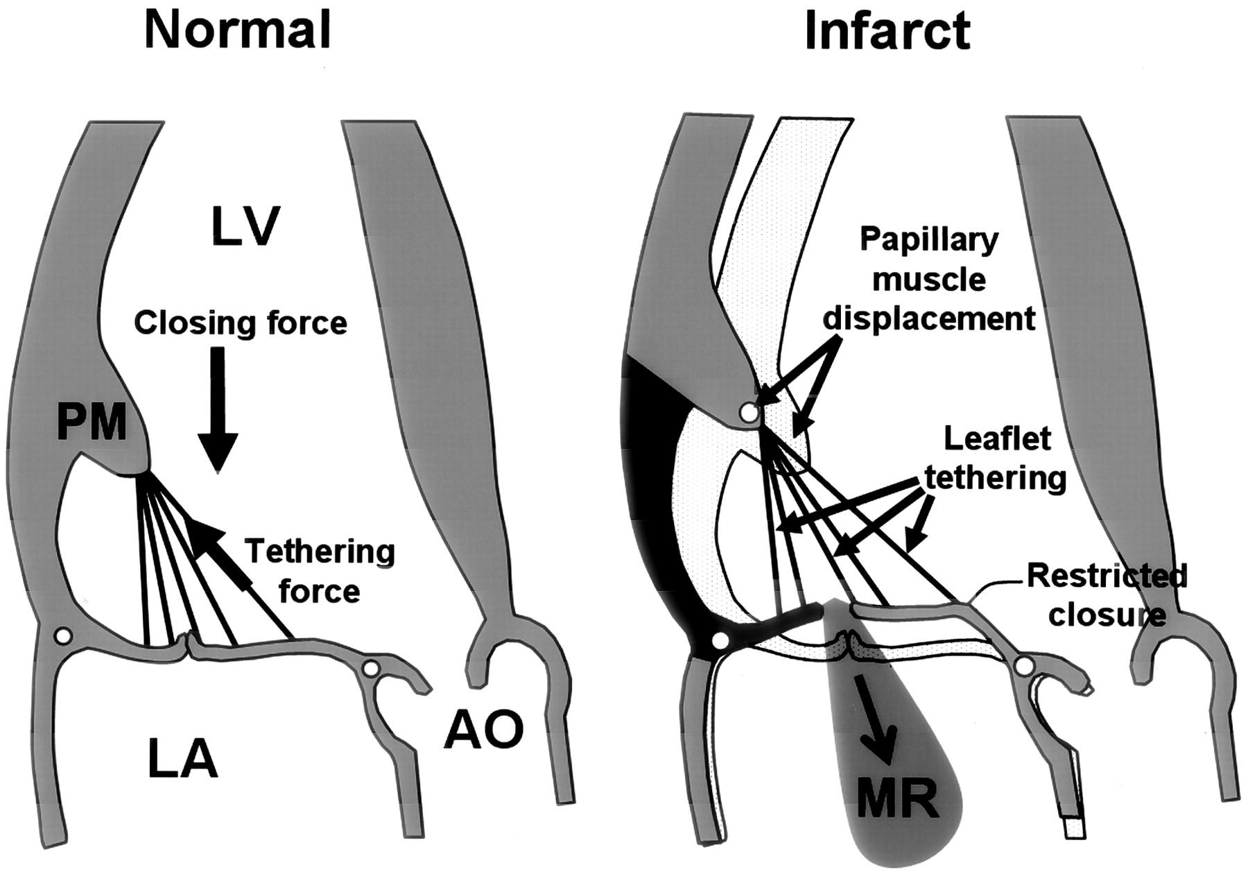 mitral leaflets in systole.