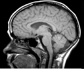 Corpus callosum avvik Mattson et al.