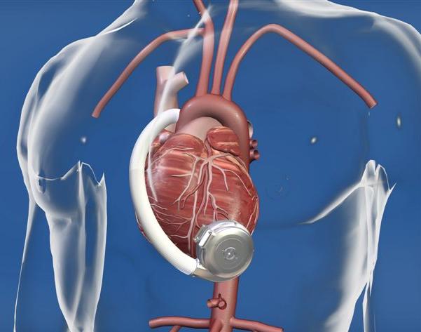 Implanterbar LVAD som bro til hjertetransplantasjon og for varig behandling ved alvorlig