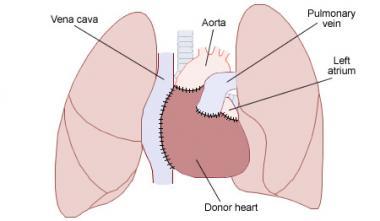 Pasientforløp Hjerte lunge TX/ LVAD TX utredning 1 uke Akuttmotakk Henvisning TX venteliste Pre TX LVAD fase TKA