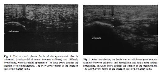 Laser ved plantar fasciitis Etter laser ble senetykkelsen redusert ti 3.63 (±0.98) mm, mens placebo gruppen holdt 4.38 (±1.