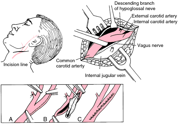 Behandling karotisstenose Asymptomatisk karotisstenose: Symptomgivende stenose: Som hovedregel ikke operasjon Menn med stenosegrad > 60?